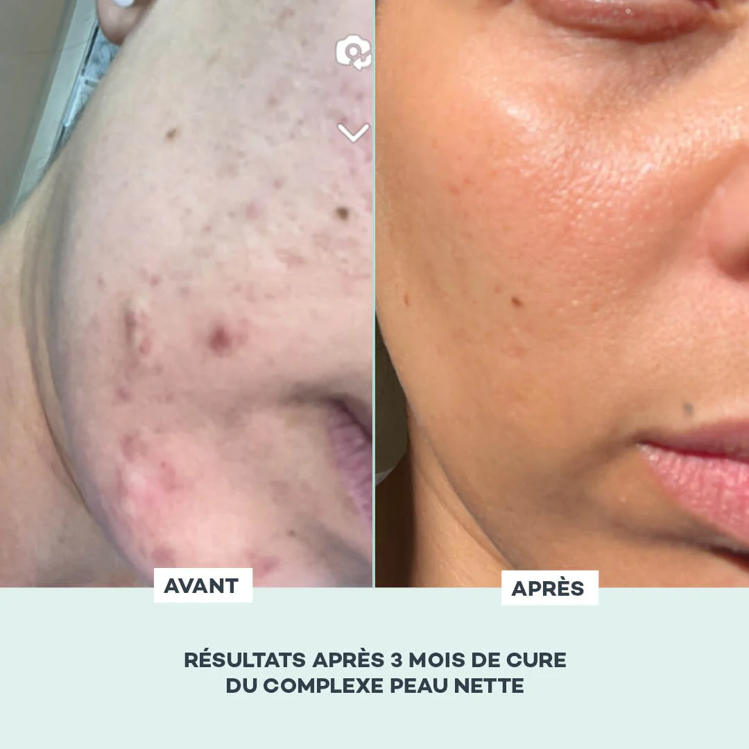 Complexe Peau Nette - Image 3